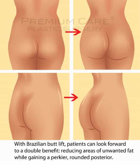 Buttock Augmentation in Colombia