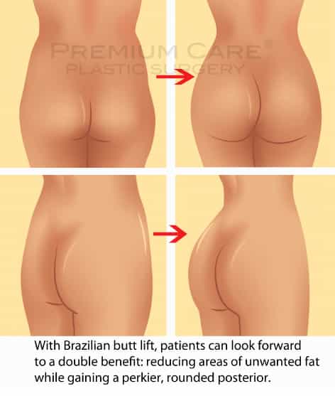 Buttock Augmentation in Colombia Buttock Augmentation in Colombia