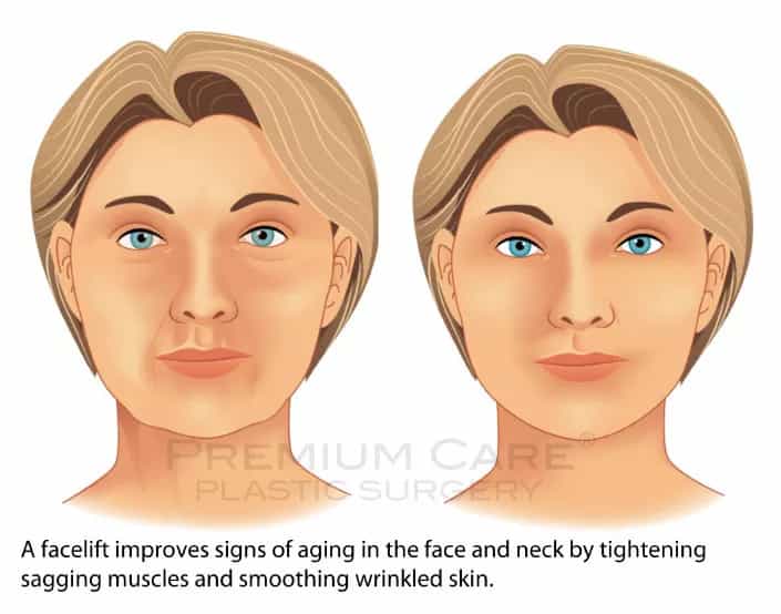 Facelift in Colombia- Premium Care Plastic Surgery