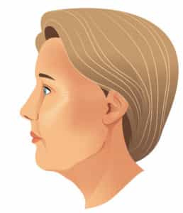 Neck Lift in Colombia - Premium Care Plastic Surgery