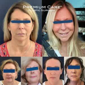 Facelift Colombia - Premium Care Plastic Surgery