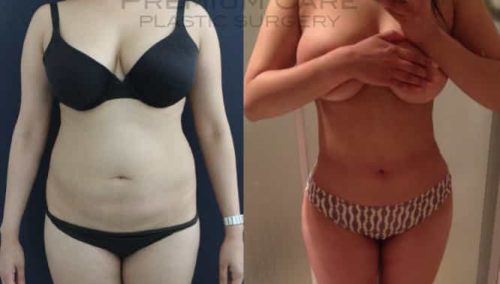 Brazilian Butt Lift gallery -Brazilian Butt Lift Cartagena Colombia - Premium Care Plastic Surgery