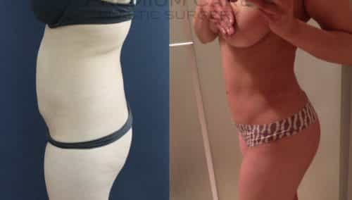 Brazilian Butt Lift gallery -Brazilian Butt Lift Cartagena Colombia - Premium Care Plastic Surgery