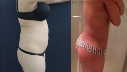 Brazilian Butt Lift gallery - Brazilian Butt Lift Cartagena Colombia - Premium Care Plastic Surgery