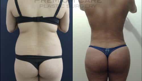 Brazilian Butt Lift gallery -Brazilian Butt Lift Colombia - Premium Care Plastic Surgery
