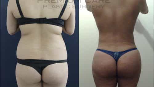 Brazilian Butt Lift Gallery - ✓ Premium Care Plastic Surgery