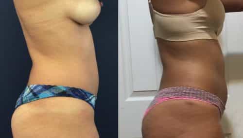 Before and After brazilian butt lift Colombia - Premium Care Plastic Surgery