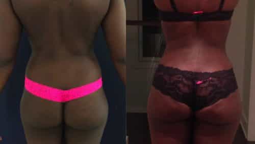 Brazilian Butt Lift Cartagena Colombia - Premium Care Plastic Surgery