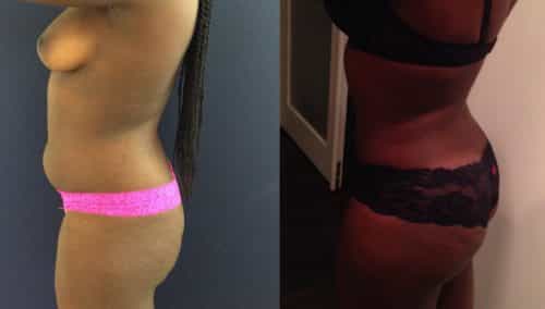Brazilian Butt Lift Cartagena Colombia - Premium Care Plastic Surgery