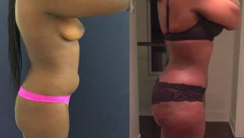 Brazilian Butt Lift Cartagena Colombia - Premium Care Plastic Surgery