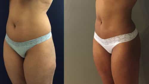 Brazilian Butt Lift gallery - Brazilian Butt Lift Cartagena Colombia - Premium Care Plastic Surgery