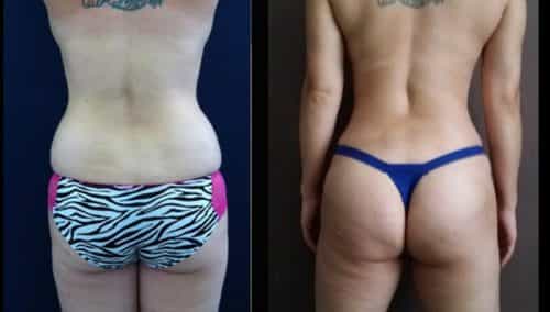 Before and After brazilian butt lift Colombia - Premium Care Plastic Surgery