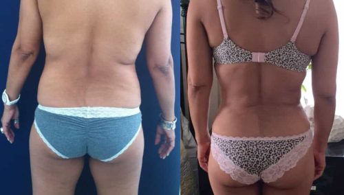 Before and After brazilian butt lift Colombia - Premium Care Plastic Surgery