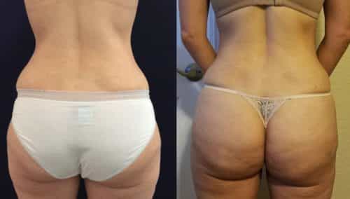 Before and After brazilian butt lift Colombia - Premium Care Plastic Surgery