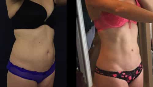 Before and After brazilian butt lift Colombia - Premium Care Plastic Surgery