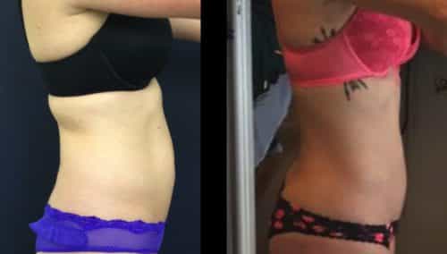 Brazilian Butt Lift Cartagena Colombia - Premium Care Plastic Surgery