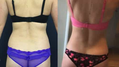 Before and After brazilian butt lift Colombia - Premium Care Plastic Surgery