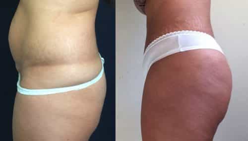 Before and After brazilian butt lift Colombia - Premium Care Plastic Surgery