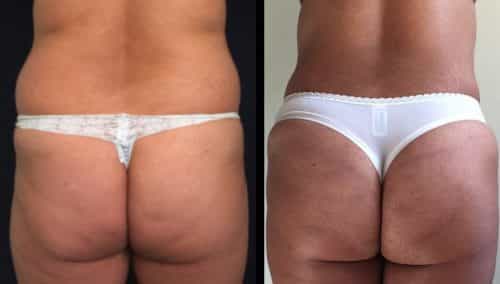 Before and After brazilian butt lift Colombia - Premium Care Plastic Surgery