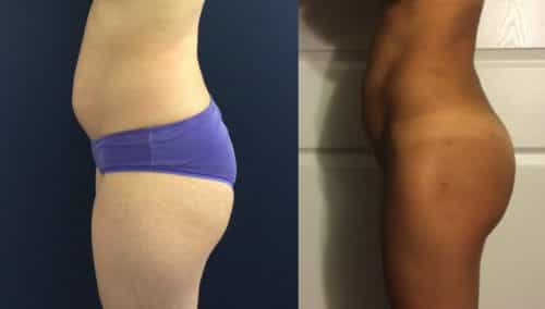 Before and After brazilian butt lift Colombia - Premium Care Plastic Surgery