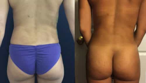 Before and After brazilian butt lift Colombia - Premium Care Plastic Surgery