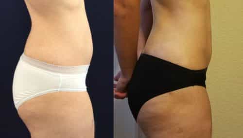 Before and After brazilian butt lift Colombia - Premium Care Plastic Surgery