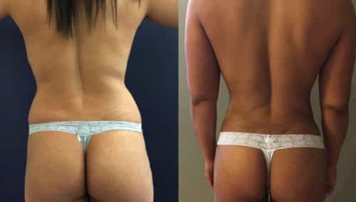 Brazilian Butt Lift gallery -Brazilian Butt Lift Cartagena Colombia - Premium Care Plastic Surgery