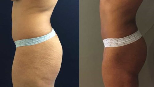 Brazilian Butt Lift gallery - Brazilian Butt Lift Cartagena Colombia - Premium Care Plastic Surgery