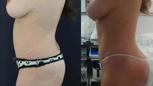 Brazilian Butt Lift Cartagena Colombia - Premium Care Plastic Surgery