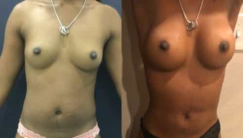 Breast Augmentation Colombia - Premium Care Plastic Surgery