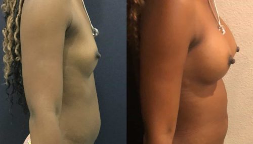 Breast Augmentation Colombia - Premium Care Plastic Surgery