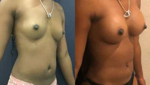 Breast Augmentation Colombia - Premium Care Plastic Surgery