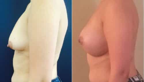 Breast Augmentation Colombia - Premium Care Plastic Surgery
