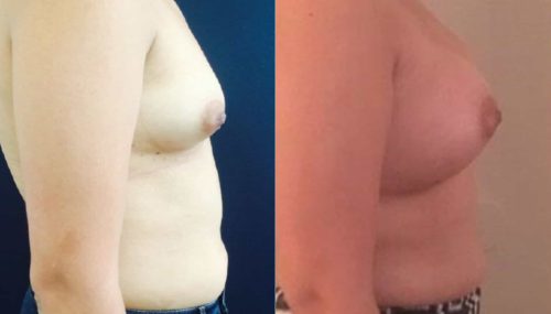 Breast Augmentation Colombia - Premium Care Plastic Surgery
