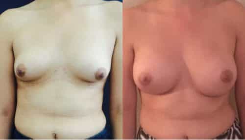 Breast Augmentation Colombia - Premium Care Plastic Surgery