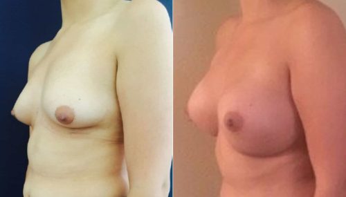 Breast Augmentation Colombia - Premium Care Plastic Surgery