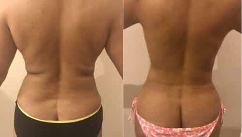 Before and after Breast Revision Colombia - Premium Care Plastic Surgery