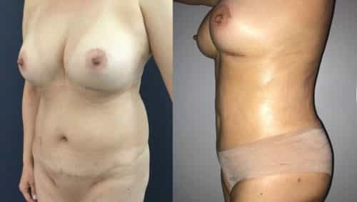 Before and after Breast Revision Colombia - Premium Care Plastic Surgery