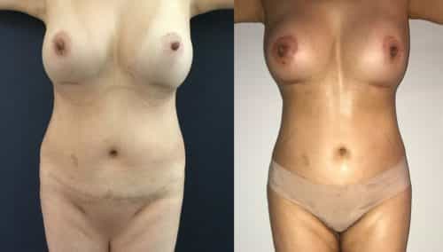 Before and after Breast Revision Colombia - Premium Care Plastic Surgery