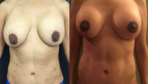 Before and after Breast Revision Colombia - Premium Care Plastic Surgery