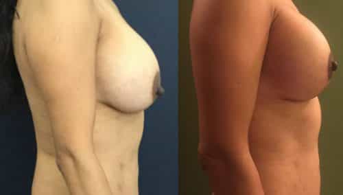 Before and after Breast Revision Colombia - Premium Care Plastic Surgery
