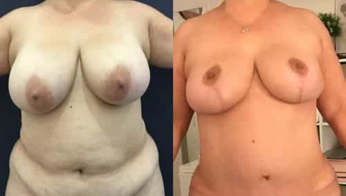 Breast Lift Colombia - Premium Care Plastic Surgery