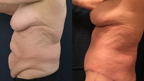 Breast Lift Colombia - Premium Care Plastic Surgery