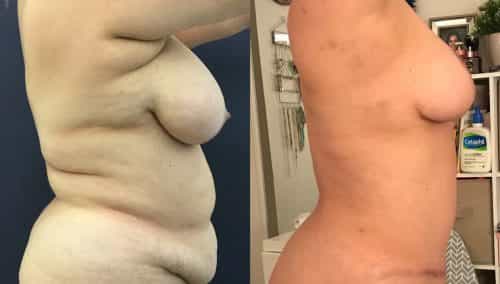 Breast Lift Colombia - Premium Care Plastic Surgery