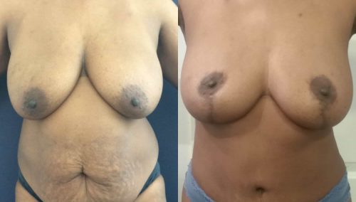 Breast Lift Colombia - Premium Care Plastic Surgery