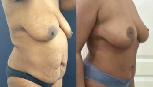 Breast Lift Colombia - Premium Care Plastic Surgery