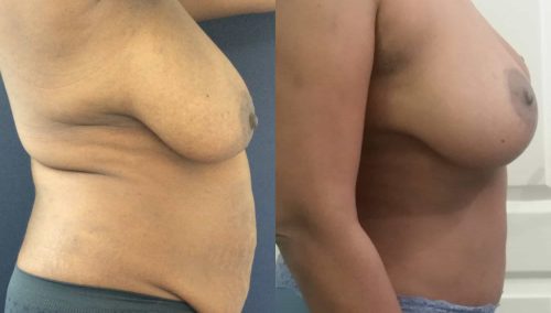 Breast Lift Colombia - Premium Care Plastic Surgery