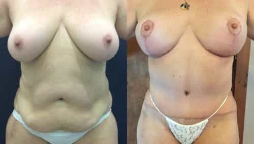 Breast Lift Colombia - Premium Care Plastic Surgery