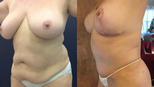 Breast Lift Colombia - Premium Care Plastic Surgery