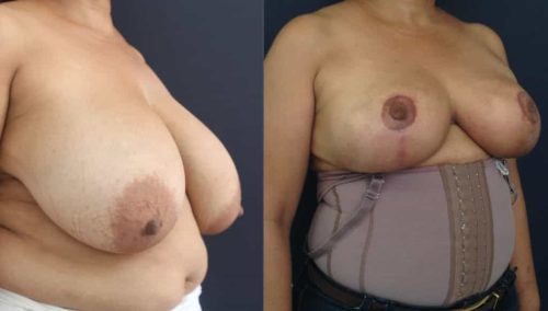 Breast Lift Colombia - Premium Care Plastic Surgery